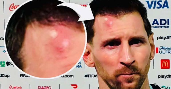Messi sưng vêu trán sau trận thắng Cabo Verde: Vì sao nên nỗi? - hình ảnh - rr88slot.vip Messi sưng vêu trán sau trận thắng Cabo Verde: Vì sao nên nỗi? - hình ảnh - rr88slot.vip
